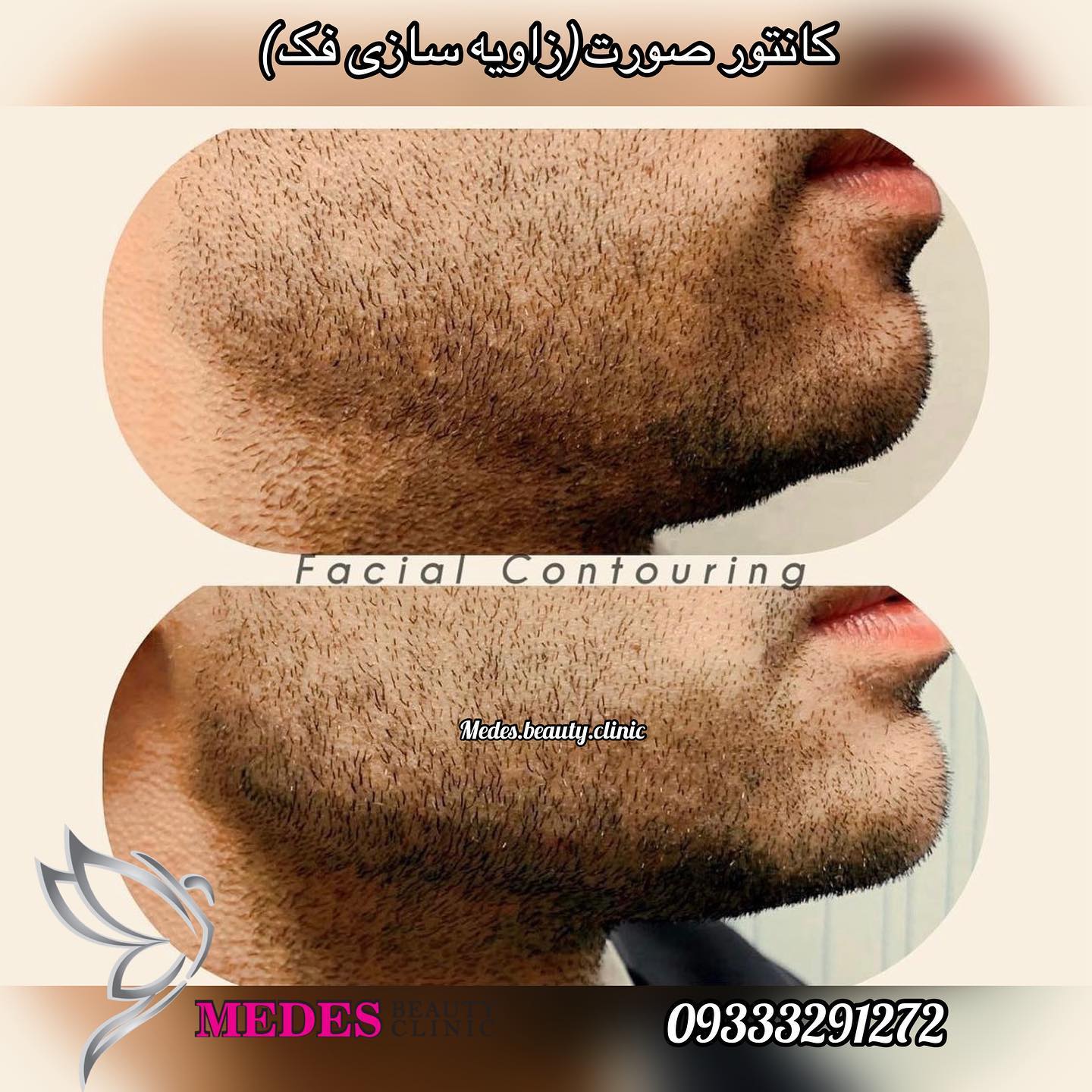 گالری زاویه سازی صورت